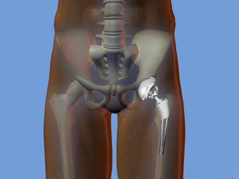 Arthroplastie de la hanche pour la douleur