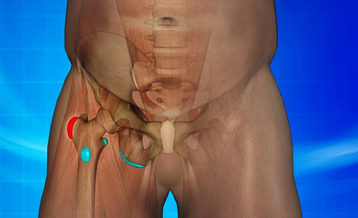 Inflammation de l'articulation de la hanche comme cause de douleur
